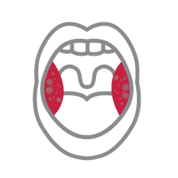 Síndrome mononucleósido